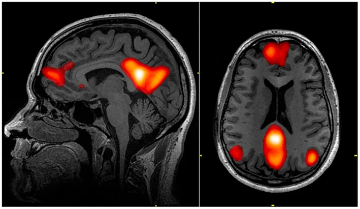 Functional connectivity map of the brain's default mode network, the self-referential circuit that activates when the brain observes itself